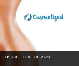 Liposuction in Acme