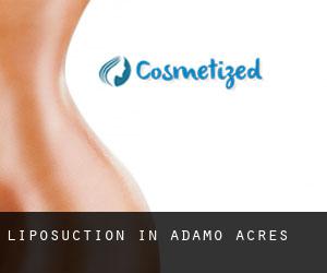 Liposuction in Adamo Acres