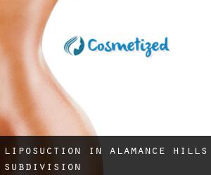 Liposuction in Alamance Hills Subdivision