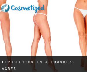 Liposuction in Alexanders Acres