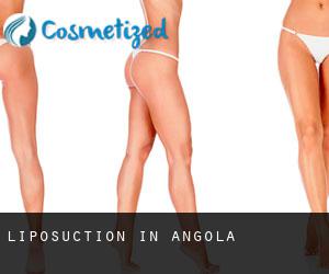 Liposuction in Angola
