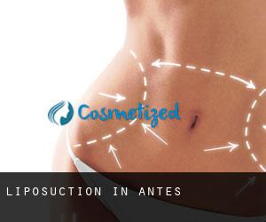 Liposuction in Antes