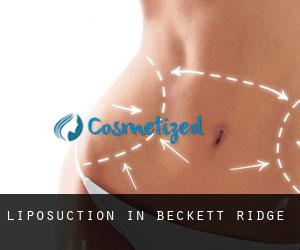 Liposuction in Beckett Ridge