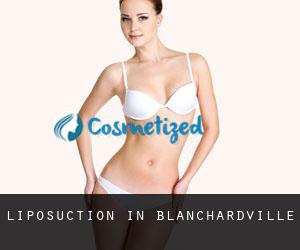 Liposuction in Blanchardville