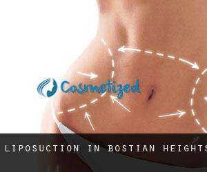 Liposuction in Bostian Heights