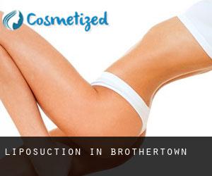 Liposuction in Brothertown