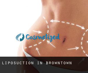 Liposuction in Browntown