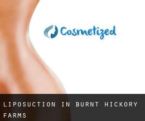 Liposuction in Burnt Hickory Farms