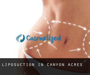 Liposuction in Canyon Acres