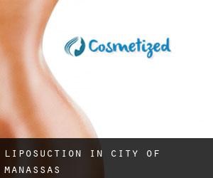 Liposuction in City of Manassas