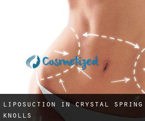 Liposuction in Crystal Spring Knolls