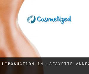 Liposuction in Lafayette Annex
