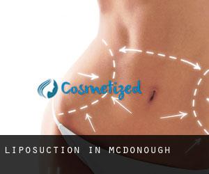 Liposuction in McDonough
