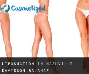 Liposuction in Nashville-Davidson (balance)