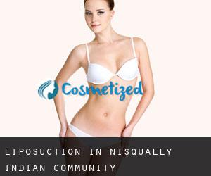 Liposuction in Nisqually Indian Community