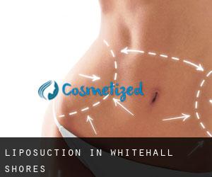 Liposuction in Whitehall Shores