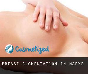 Breast Augmentation in Marye