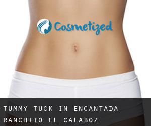 Tummy Tuck in Encantada-Ranchito-El Calaboz