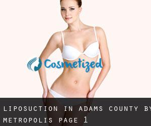 Liposuction in Adams County by metropolis - page 1