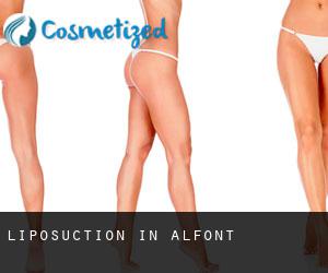 Liposuction in Alfont