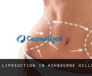 Liposuction in Ashbourne Hills