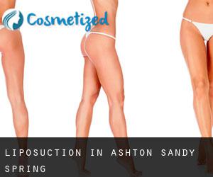 Liposuction in Ashton-Sandy Spring