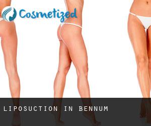 Liposuction in Bennum