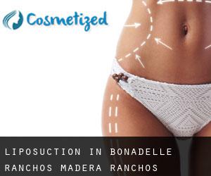 Liposuction in Bonadelle Ranchos-Madera Ranchos