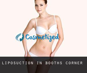 Liposuction in Booths Corner