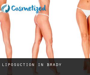 Liposuction in Brady