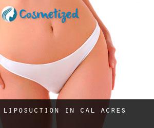 Liposuction in Cal Acres
