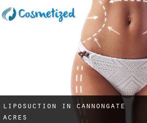 Liposuction in Cannongate Acres