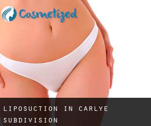 Liposuction in Carlye Subdivision