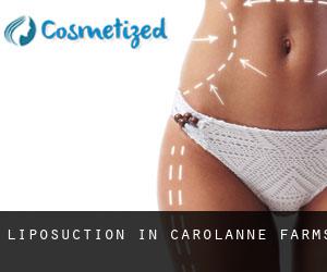 Liposuction in Carolanne Farms