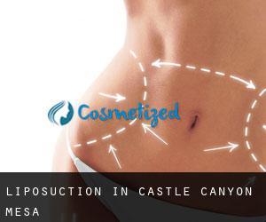 Liposuction in Castle Canyon Mesa