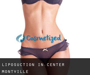 Liposuction in Center Montville