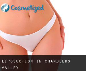 Liposuction in Chandlers Valley