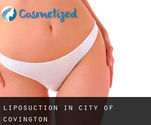 Liposuction in City of Covington Liposuction in City of Covington