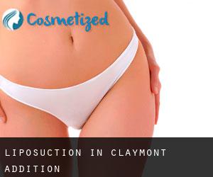 Liposuction in Claymont Addition