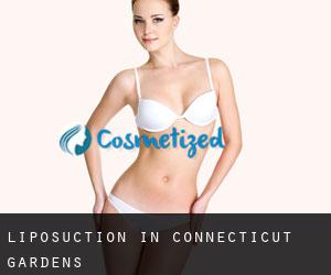 Liposuction in Connecticut Gardens