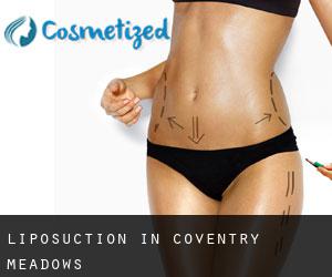 Liposuction in Coventry Meadows