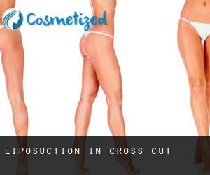 Liposuction in Cross Cut