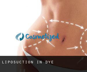 Liposuction in Dye