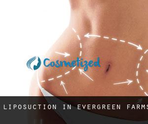 Liposuction in Evergreen Farms