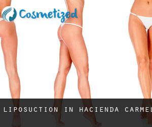 Liposuction in Hacienda Carmel