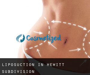 Liposuction in Hewitt Subdivision