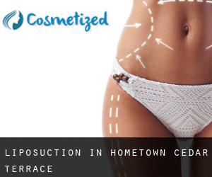 Liposuction in Hometown-Cedar Terrace