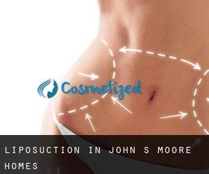 Liposuction in John S Moore Homes