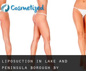 Liposuction in Lake and Peninsula Borough by metropolitan area - page 1