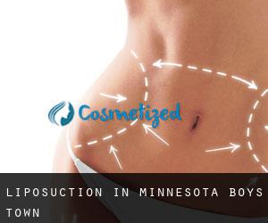 Liposuction in Minnesota Boys Town